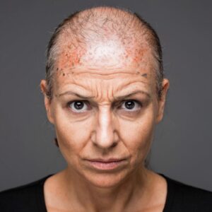 Выпадение волос у женщин — факторы развития, симптомы и современная терапия