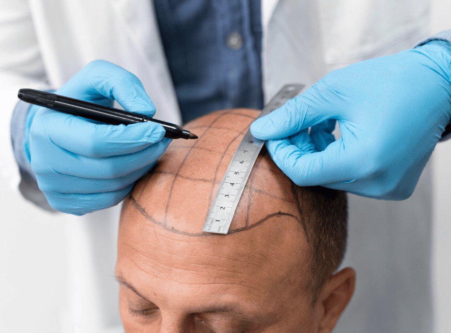 Мужчина проходит процесс извлечения фолликулярной единицы