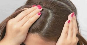 Перхоть на проборе волос у женщины, вид крупным планом